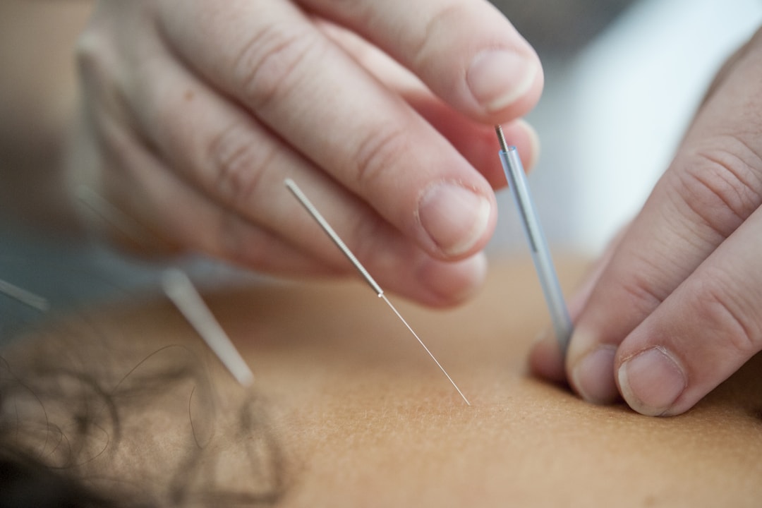 AcupuncturÄ tradiČ›ionalÄ chinezÄ HĂ®nceČ™ti - ace pe meridiane